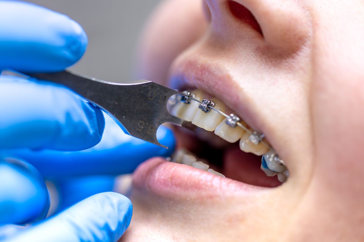 The Ultimate Guide to Orthodontics: Braces & Clear Aligners