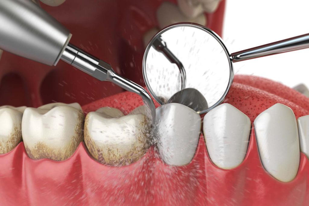 Illustration of dental tools cleaning teeth to prevent plaque and gum disease.